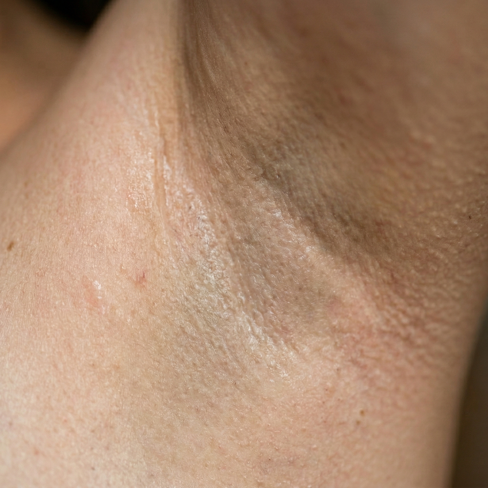 Nachher-Bild Achseln nach Laser Haarentfernung bei Laserazor