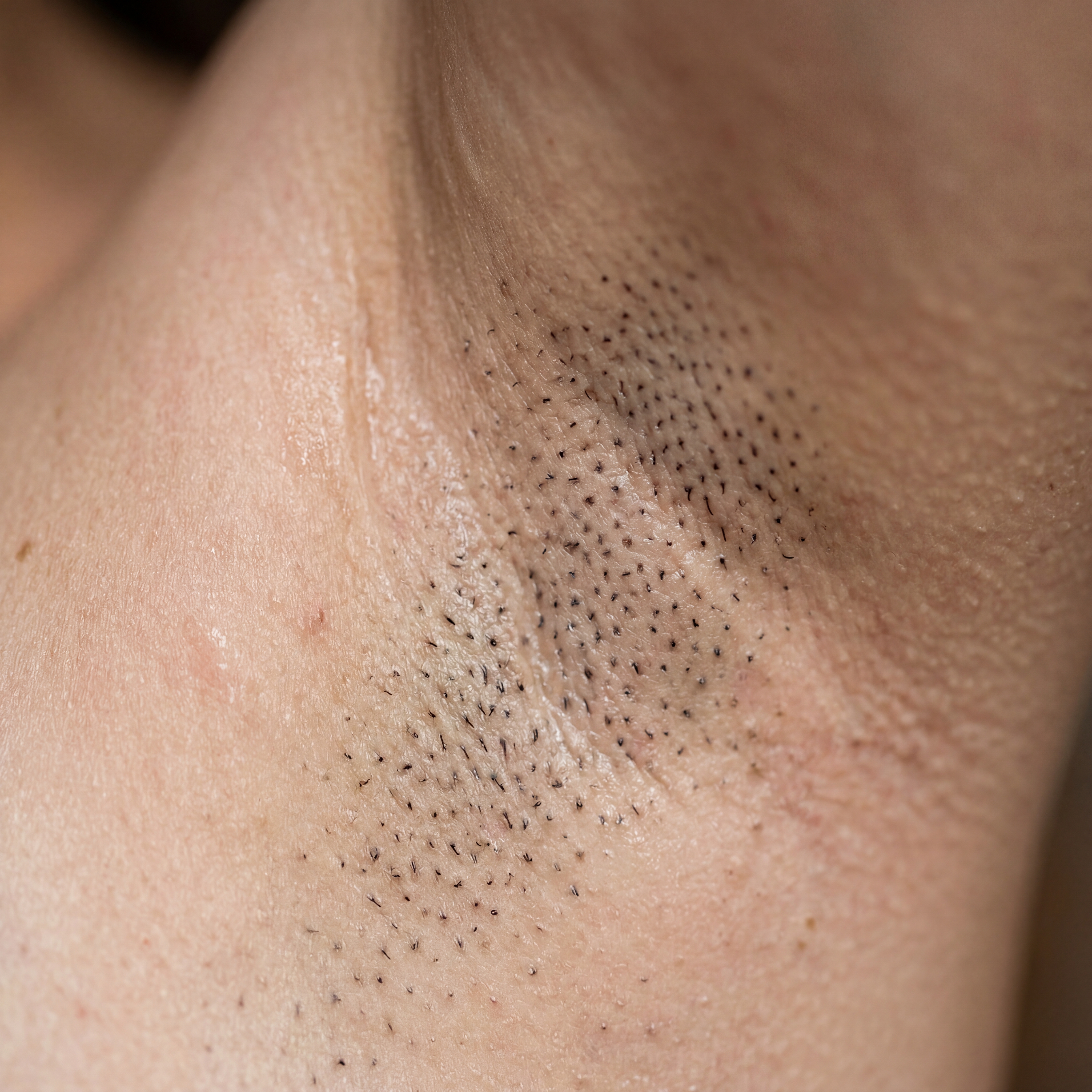 Vorher-Bild Achseln vor Laser Haarentfernung bei Laserazor