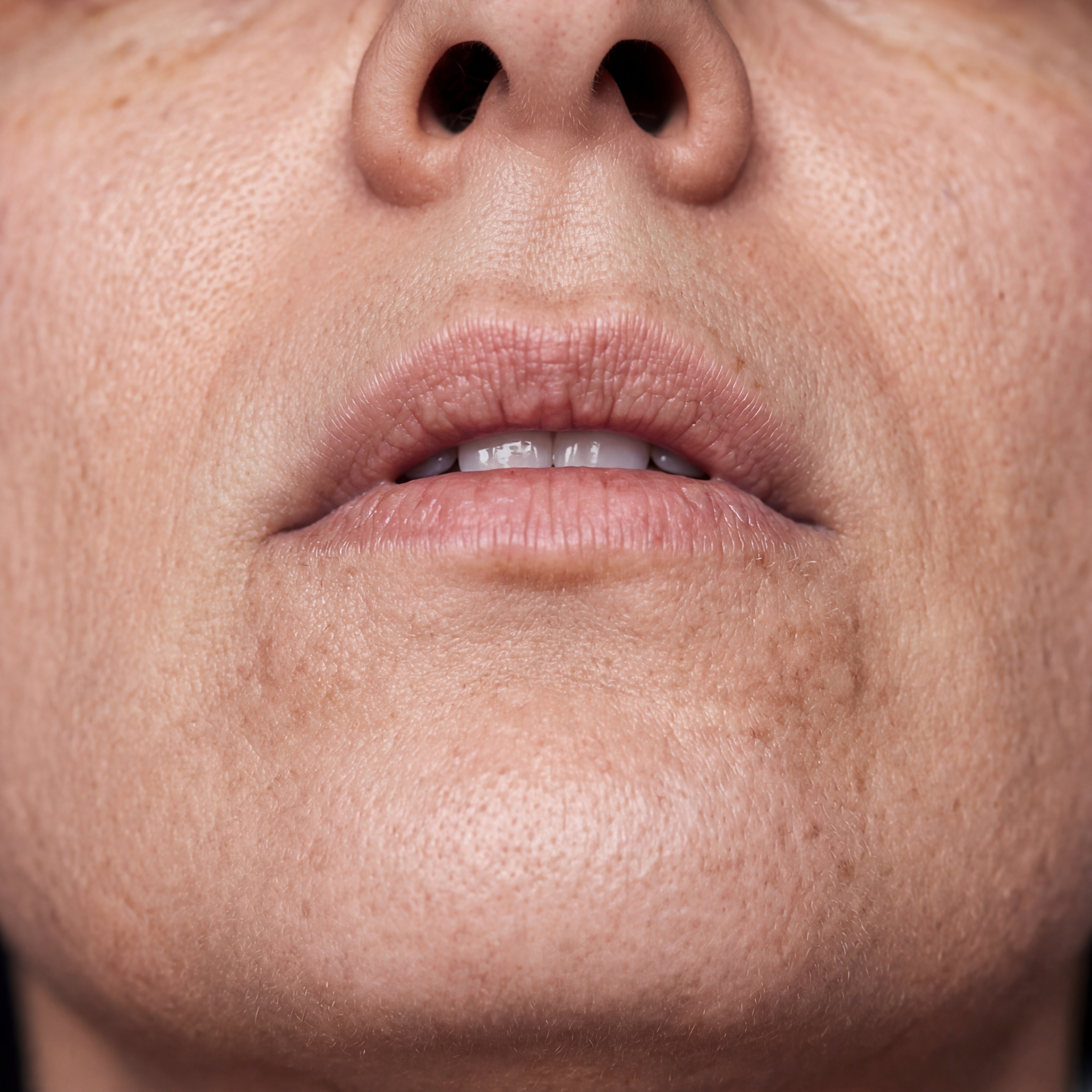 Nachher-Bild Kinn nach Laser Haarentfernung bei Laserazor