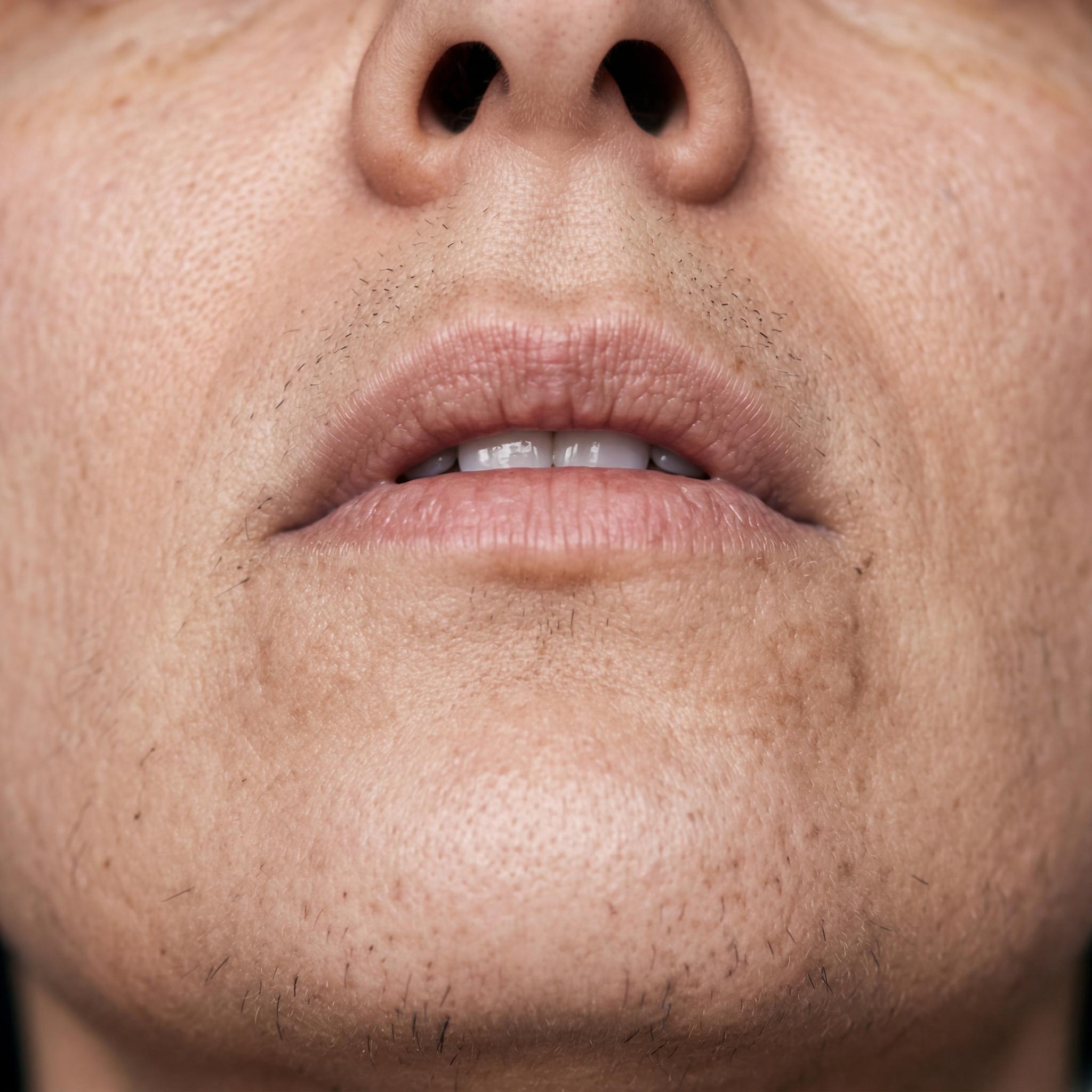 Vorher-Bild Kinn vor Laser Haarentfernung bei Laserazor